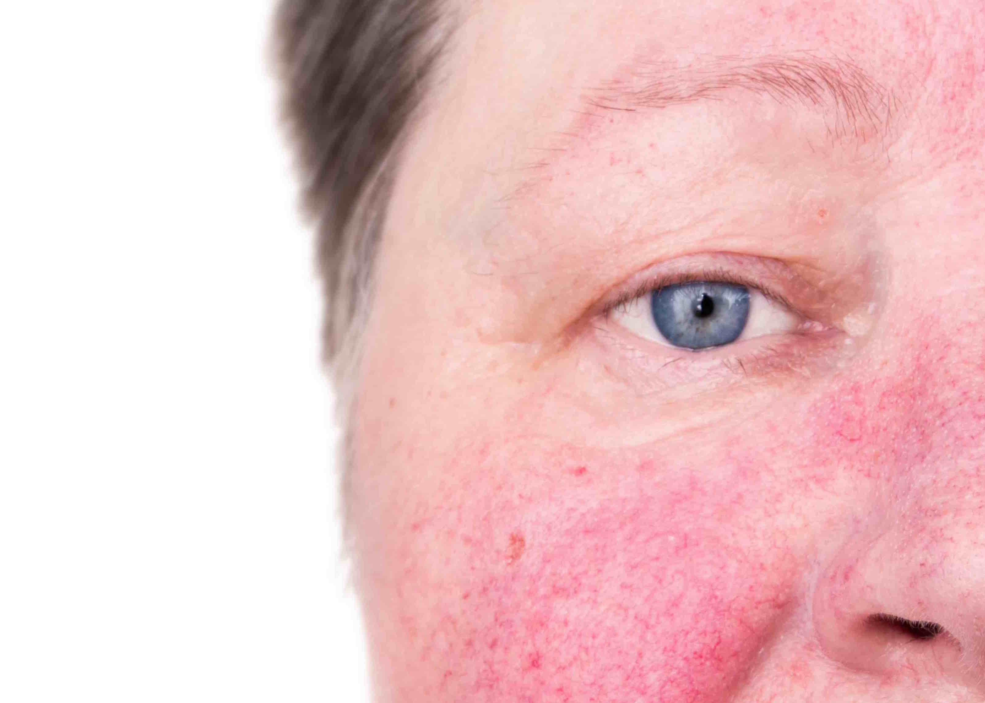 Rosacea 